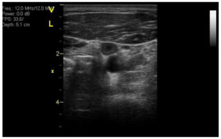 establishing-a-vte-risk-score-for-astronauts-algorithm